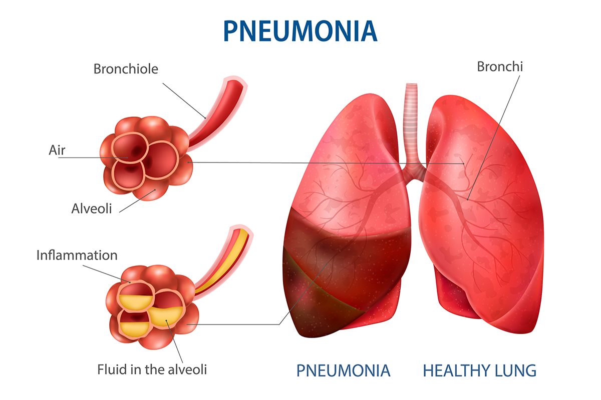Pneumonia in Hadapsar